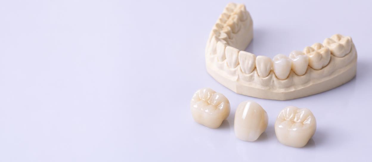 Precision ceramic dental restorations
